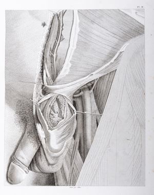 Traité pratique des Hernies